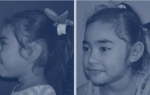 photo of child with ear surgery